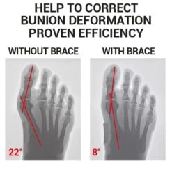 Epitact Flexible Bunion Corrector -Sports Protective Gear Store epitact flexible bunion corrector3